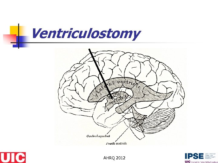 SURGICAL OUTCOMES Ventriculostomy Practice on a Library of