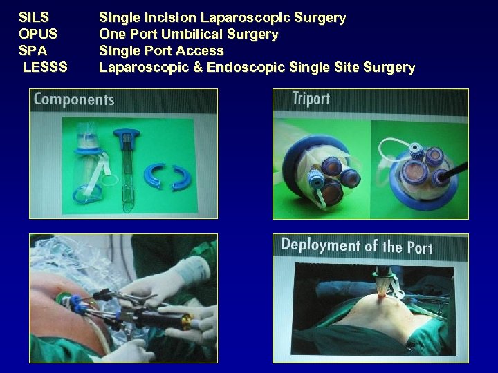 SILS OPUS SPA LESSS Single Incision Laparoscopic Surgery One Port Umbilical Surgery Single Port