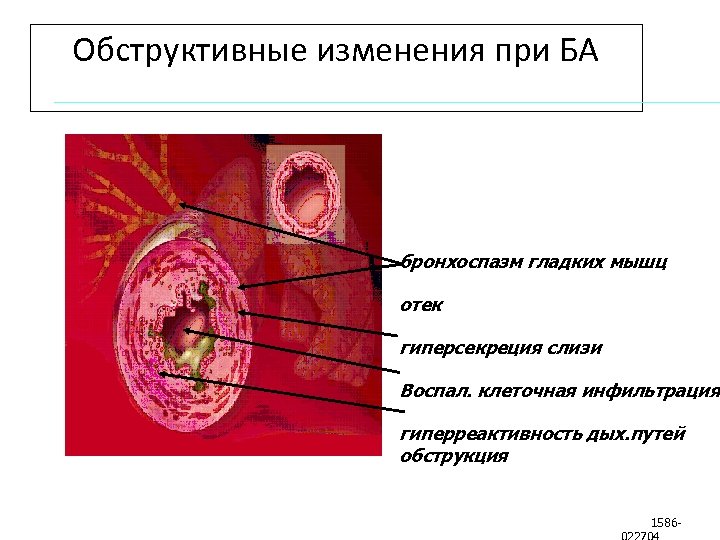 Обструктивные изменения при БА бронхоспазм гладких мышц отек гиперсекреция слизи Воспал. клеточная инфильтрация гиперреактивность
