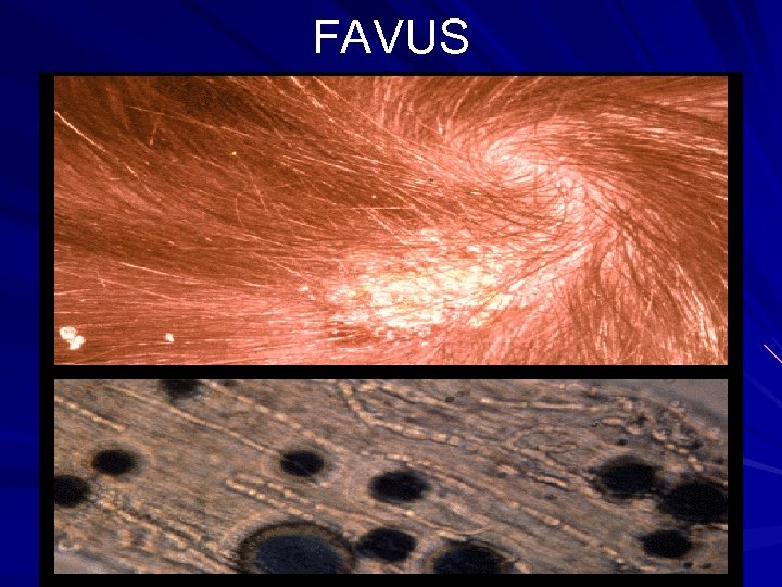 FAVUS 