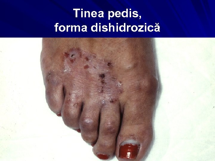 Tinea pedis, forma dishidrozică 