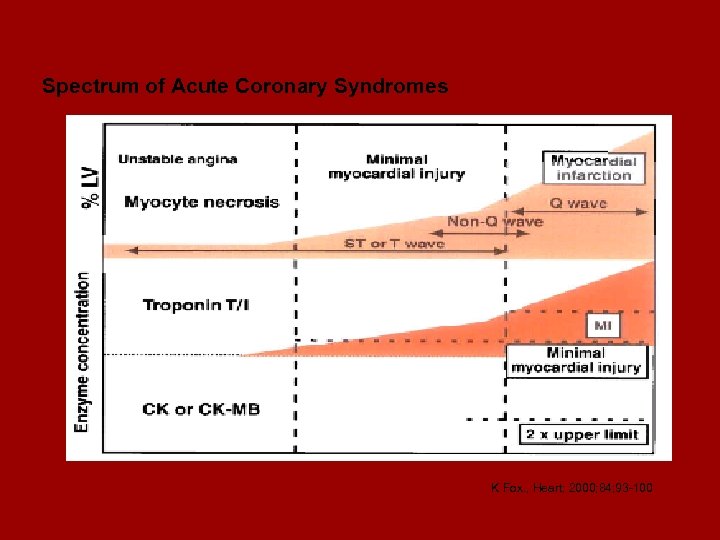 Spectrum of Acute Coronary Syndromes K Fox. , Heart; 2000; 84; 93 -100 