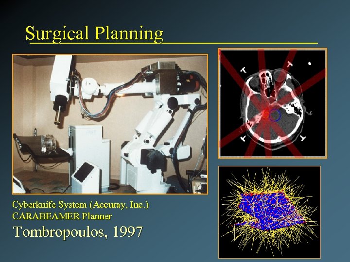 Surgical Planning Cyberknife System (Accuray, Inc. ) CARABEAMER Planner Tombropoulos, 1997 