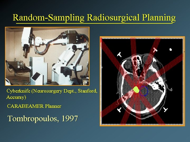 Random-Sampling Radiosurgical Planning Cyberknife (Neurosurgery Dept. , Stanford, Accuray) CARABEAMER Planner Tombropoulos, 1997 