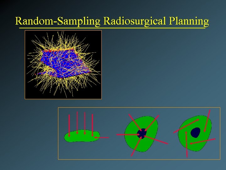 Random-Sampling Radiosurgical Planning 
