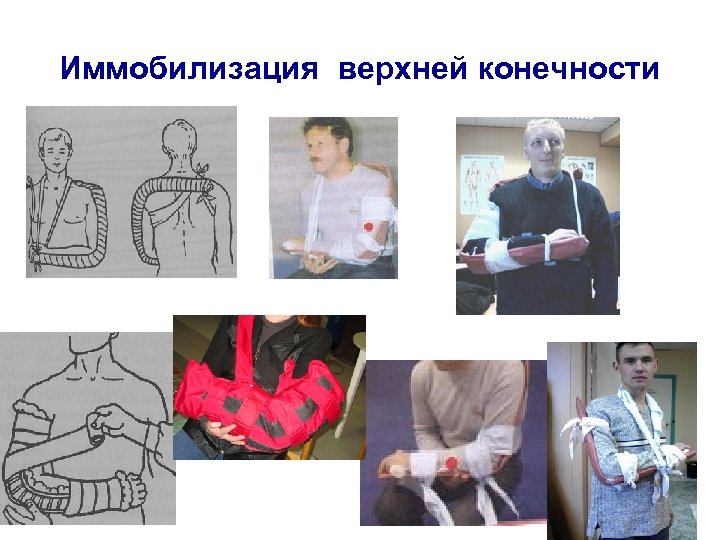 Иммобилизация верхней конечности 