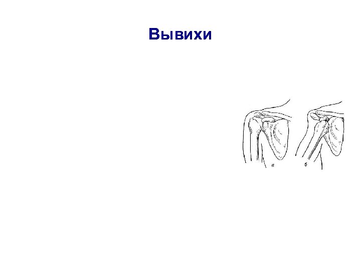 Вывихи 