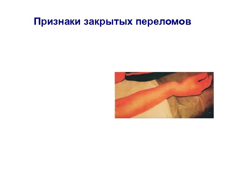 Признаки закрытых переломов 