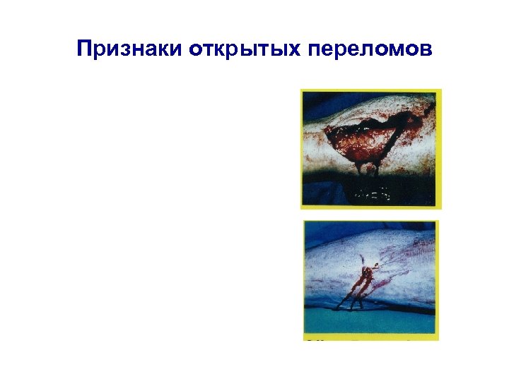 Признаки открытой. 12. Признаки открытого перелома. Признакам открытого пироломаотносится. НАЗОМ\Вите признаки открытого перелома. Как ощущается открытый перелом.