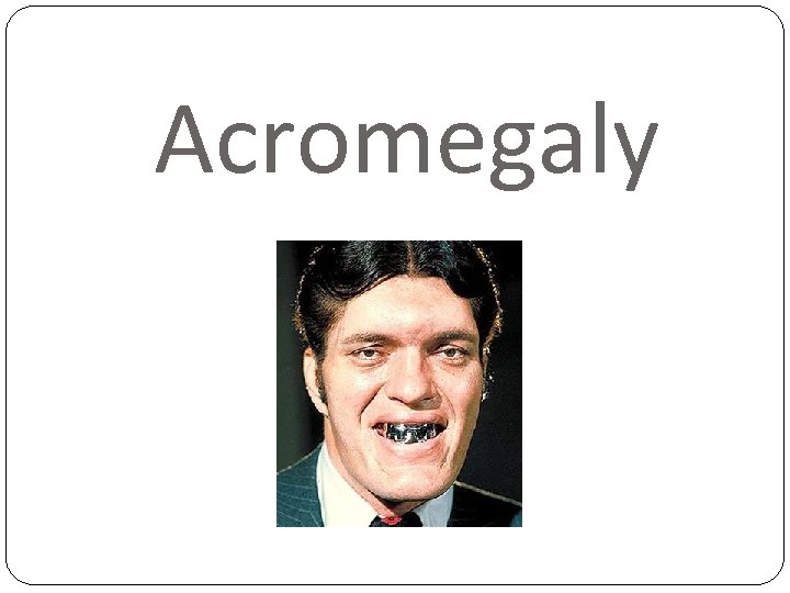 Acromegaly 