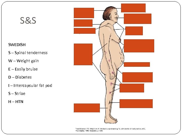 S&S SWEDISH S – Spinal tenderness W – Weight gain E – Easily bruise