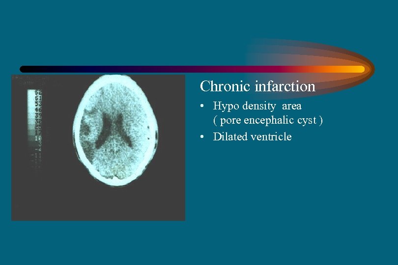 Chronic infarction • Hypo density area ( pore encephalic cyst ) • Dilated ventricle