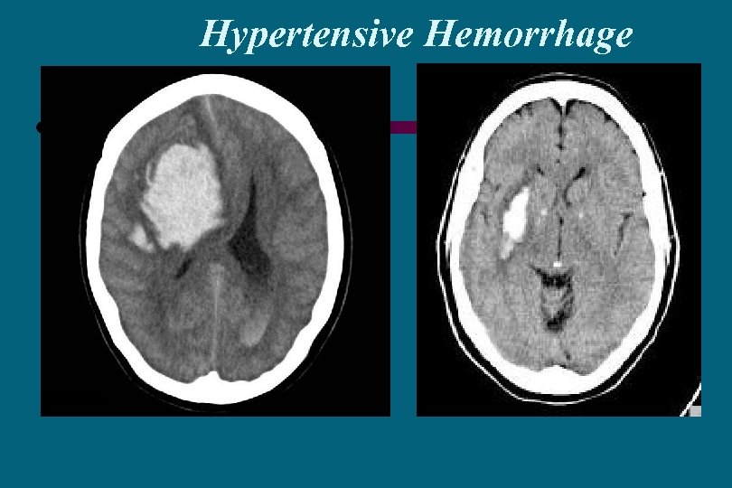 Hypertensive Hemorrhage 