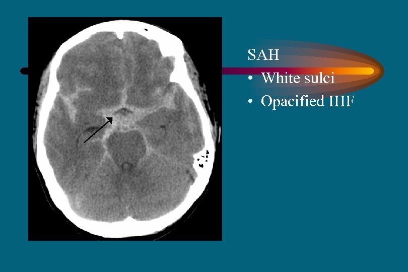 SAH • White sulci • Opacified IHF 