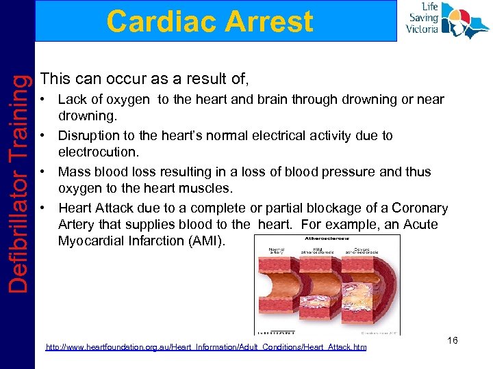 Defibrillator Training Cardiac Arrest This can occur as a result of, • Lack of