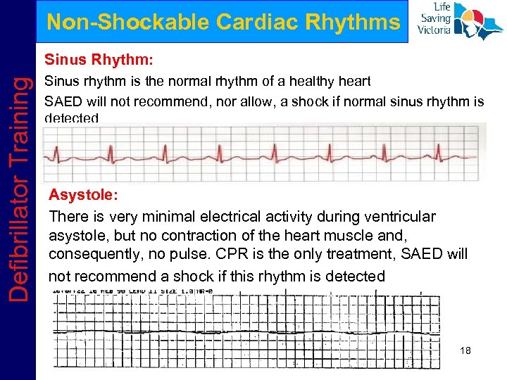 Non-Shockable Cardiac Rhythms Defibrillator Training Sinus Rhythm: Sinus rhythm is the normal rhythm of
