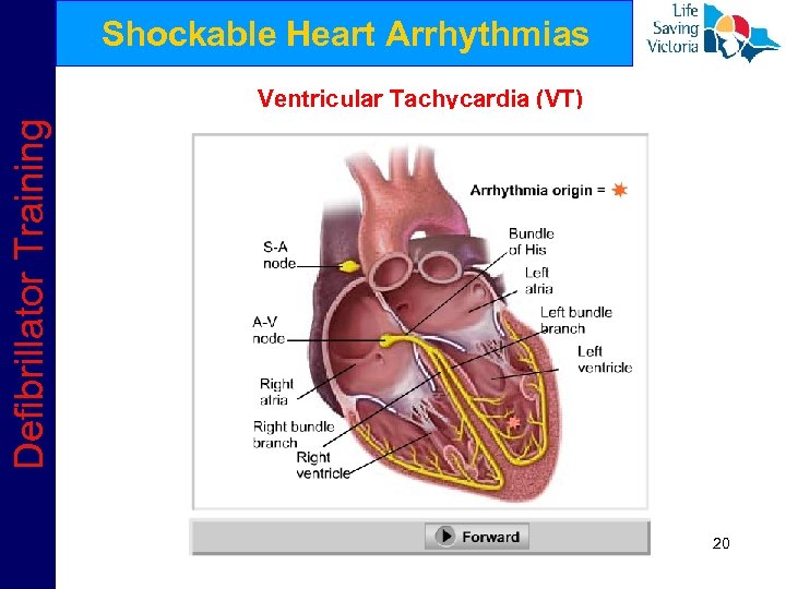 Shockable Heart Arrhythmias Defibrillator Training Ventricular Tachycardia (VT) 20 