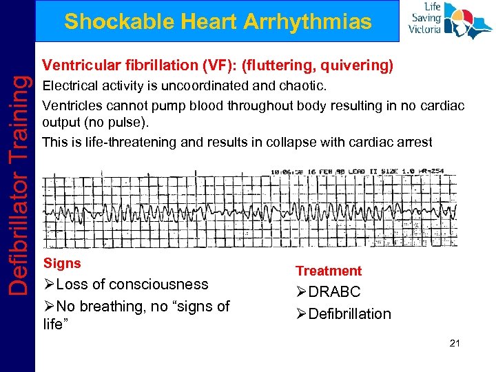 Shockable Heart Arrhythmias Defibrillator Training Ventricular fibrillation (VF): (fluttering, quivering) Electrical activity is uncoordinated