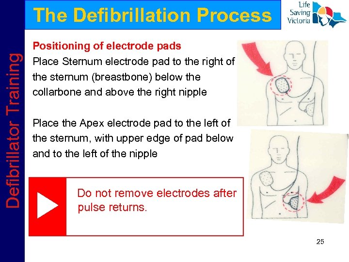 Defibrillator Training The Defibrillation Process Positioning of electrode pads Place Sternum electrode pad to