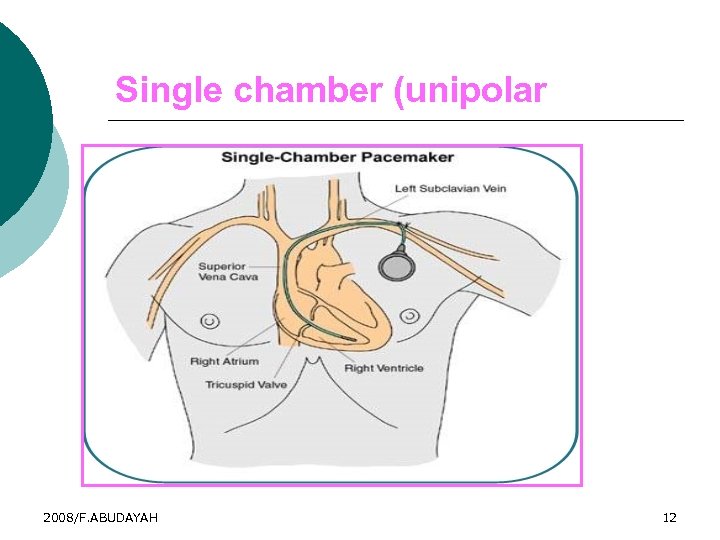 Single chamber (unipolar 2008/F. ABUDAYAH 12 