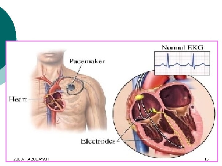 Dual-chamber (bipolar) pacemaker 2008/F. ABUDAYAH 15 