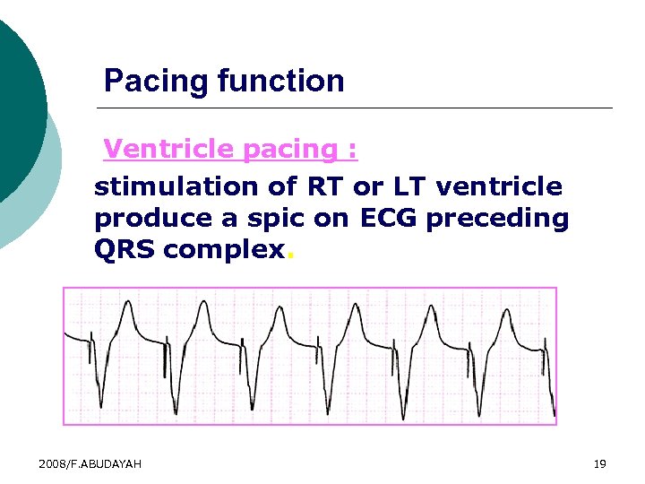 Pacing function Ventricle pacing : stimulation of RT or LT ventricle produce a spic