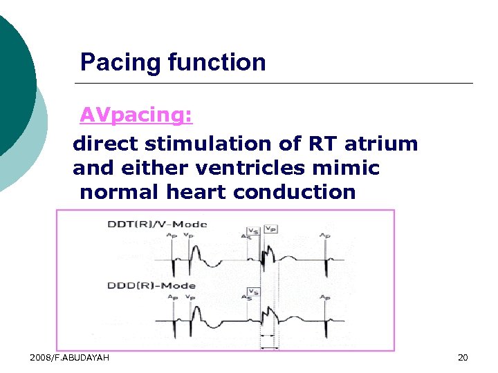 Pacing function AVpacing: direct stimulation of RT atrium and either ventricles mimic normal heart