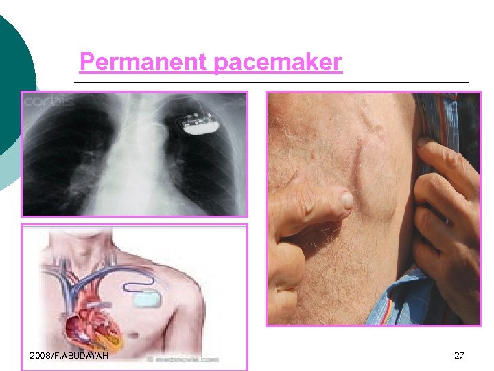 Permanent pacemaker 2008/F. ABUDAYAH 27 