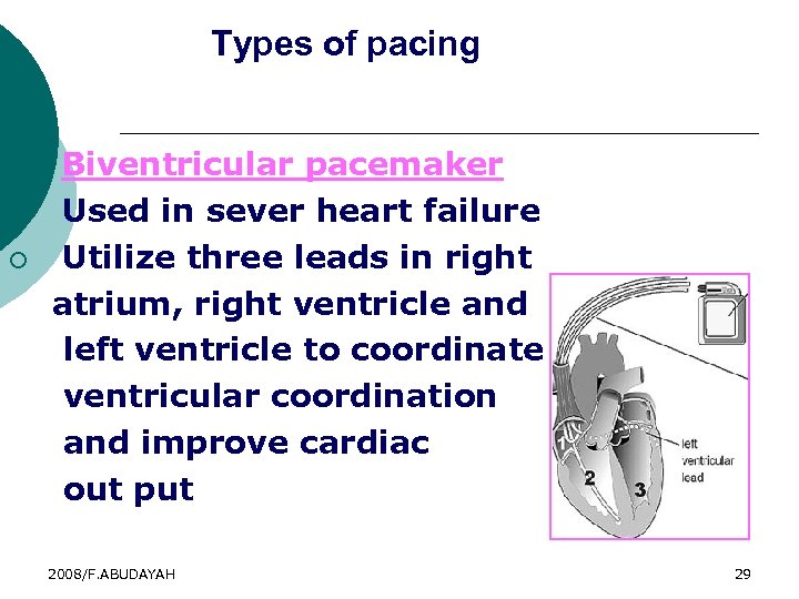 Types of pacing 3. ¡ ¡ Biventricular pacemaker Used in sever heart failure Utilize