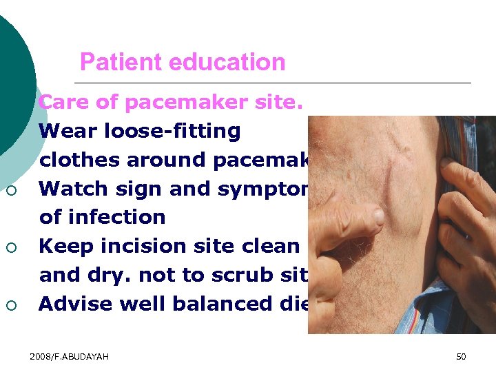 Patient education 6. ¡ ¡ Care of pacemaker site. Wear loose-fitting clothes around pacemaker