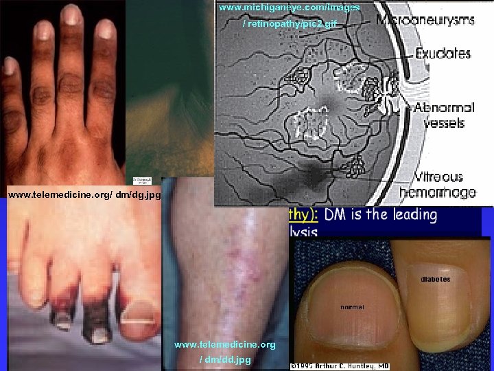www. michiganeye. com/images / retinopathy/pic 2. gif www. telemedicine. org/ dm/dg. jpg www. telemedicine.