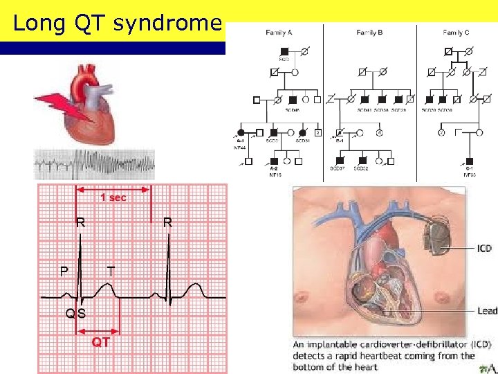 Long QT syndrome 