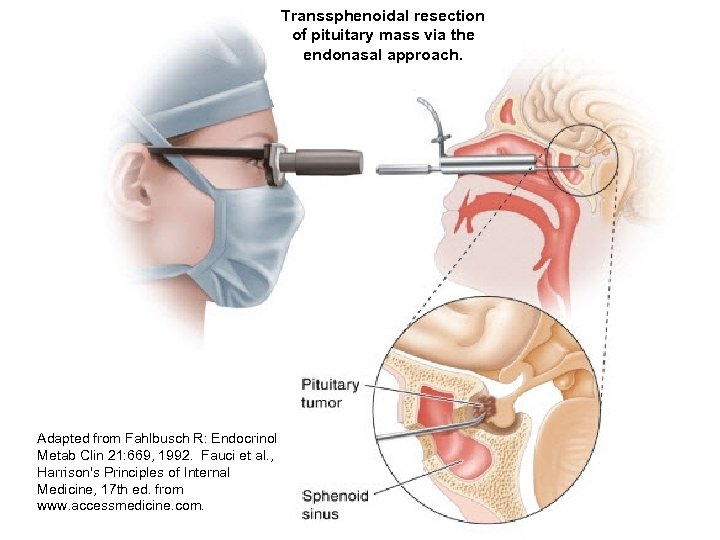 Transsphenoidal resection of pituitary mass via the endonasal approach. Adapted from Fahlbusch R: Endocrinol