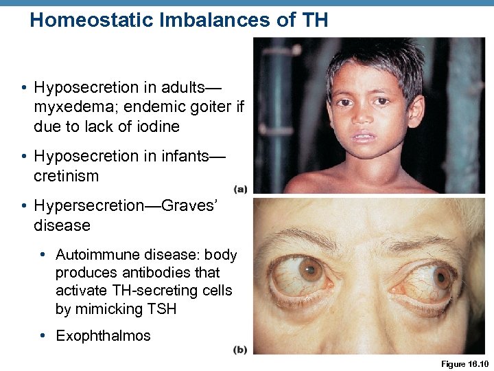 Homeostatic Imbalances of TH • Hyposecretion in adults— myxedema; endemic goiter if due to