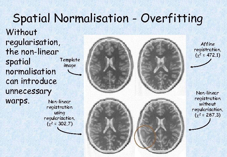 Spatial Normalisation - Overfitting Without regularisation, the non-linear Template spatial image normalisation can introduce