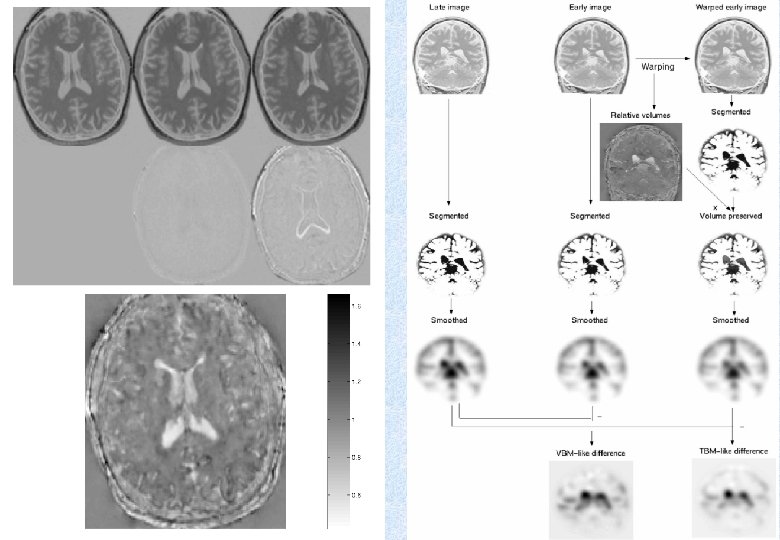 Early Late Difference Data from the Dementia Research Group, Queen Square. 