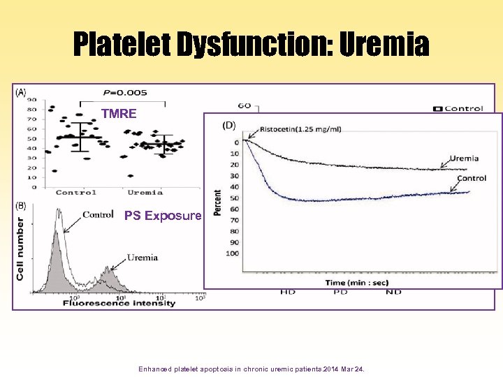 Platelet Dysfunction: Uremia TMRE PS Exposure Enhanced platelet apoptosis in chronic uremic patients. 2014