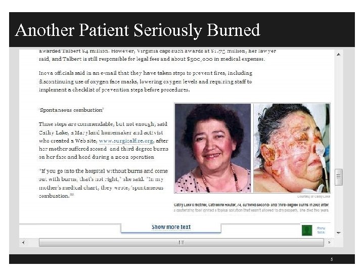 Another Patient Seriously Burned 5 