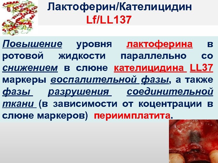  Лактоферин/Кателицидин Lf/LL 137 Повышение уровня лактоферина в ротовой жидкости параллельно со снижением в