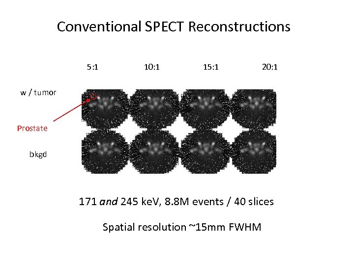 Conventional SPECT Reconstructions 5: 1 10: 1 15: 1 20: 1 w / tumor
