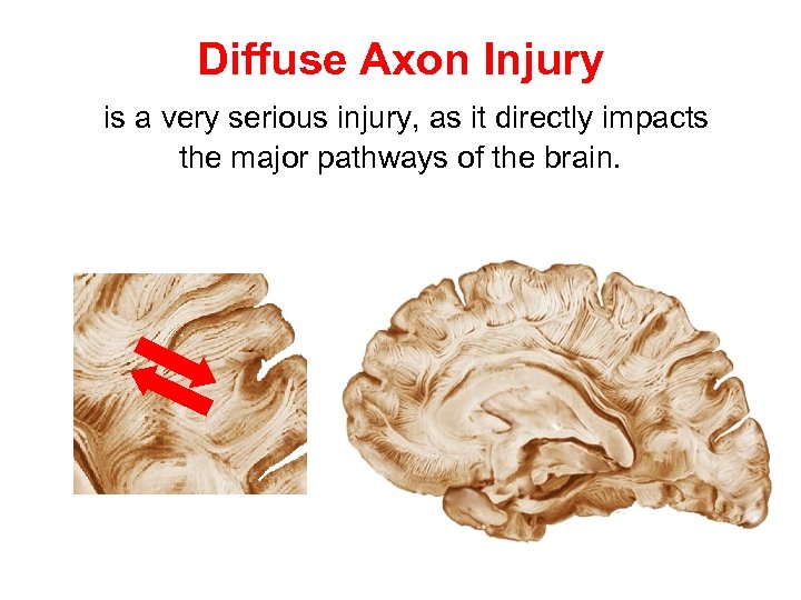 Diffuse Axon Injury is a very serious injury, as it directly impacts the major