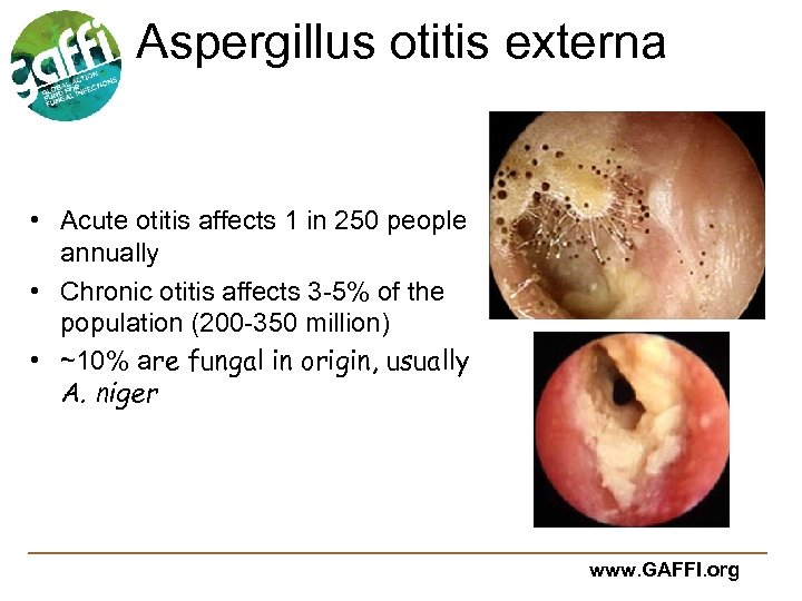 Aspergillus otitis externa • Acute otitis affects 1 in 250 people annually • Chronic