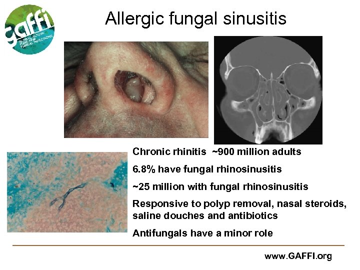 Allergic fungal sinusitis Chronic rhinitis ~900 million adults 6. 8% have fungal rhinosinusitis ~25