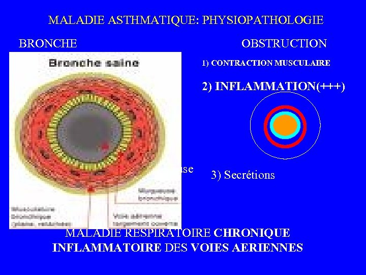  MALADIE ASTHMATIQUE: PHYSIOPATHOLOGIE BRONCHE NX OBSTRUCTION muscle muqueuse 1) CONTRACTION MUSCULAIRE 2) INFLAMMATION(+++)