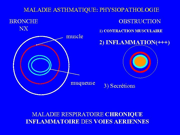  MALADIE ASTHMATIQUE: PHYSIOPATHOLOGIE BRONCHE NX OBSTRUCTION muscle muqueuse 1) CONTRACTION MUSCULAIRE 2) INFLAMMATION(+++)