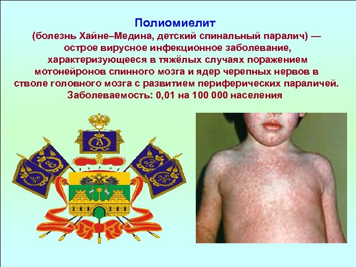 Полиомиелит (болезнь Хайне–Медина, детский спинальный паралич) — острое вирусное инфекционное заболевание, характеризующееся в тяжёлых