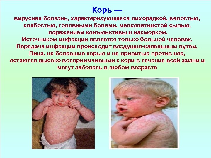 Корь — вирусная болезнь, характеризующаяся лихорадкой, вялостью, слабостью, головными болями, мелкопятнистой сыпью, поражением конъюнктивы