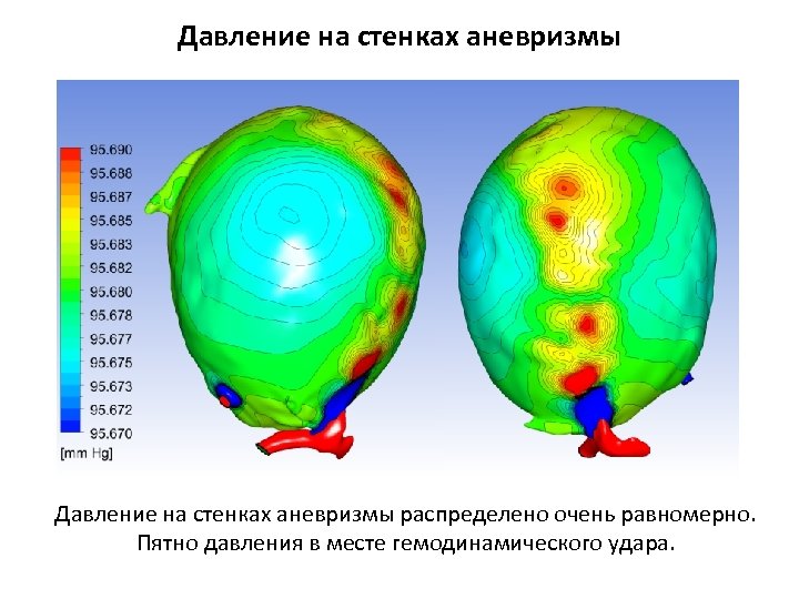 Давление на стенках аневризмы распределено очень равномерно. Пятно давления в месте гемодинамического удара. 