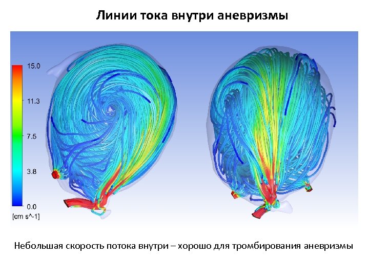 Линии тока внутри аневризмы Небольшая скорость потока внутри – хорошо для тромбирования аневризмы 