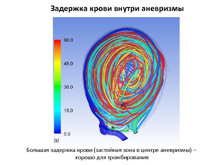 Задержка крови внутри аневризмы Большая задержка крови (застойная зона в центре аневризмы) – хорошо